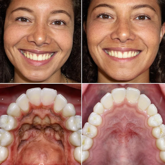 CollaGum Pro – Intensive Zahnfleischpflege mit Kollagen & Hydroxylapatit
